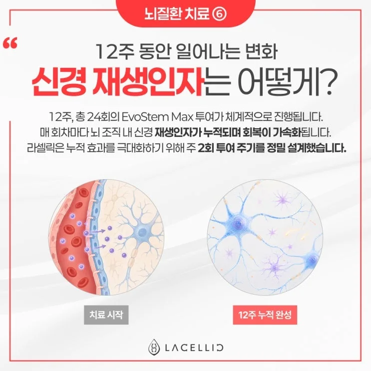 뇌 건강 의료관광, 치료부터 사후관리까지 라셀릭 메디컬 투어